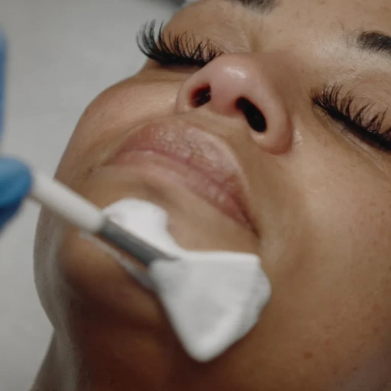 chemical-peels-black