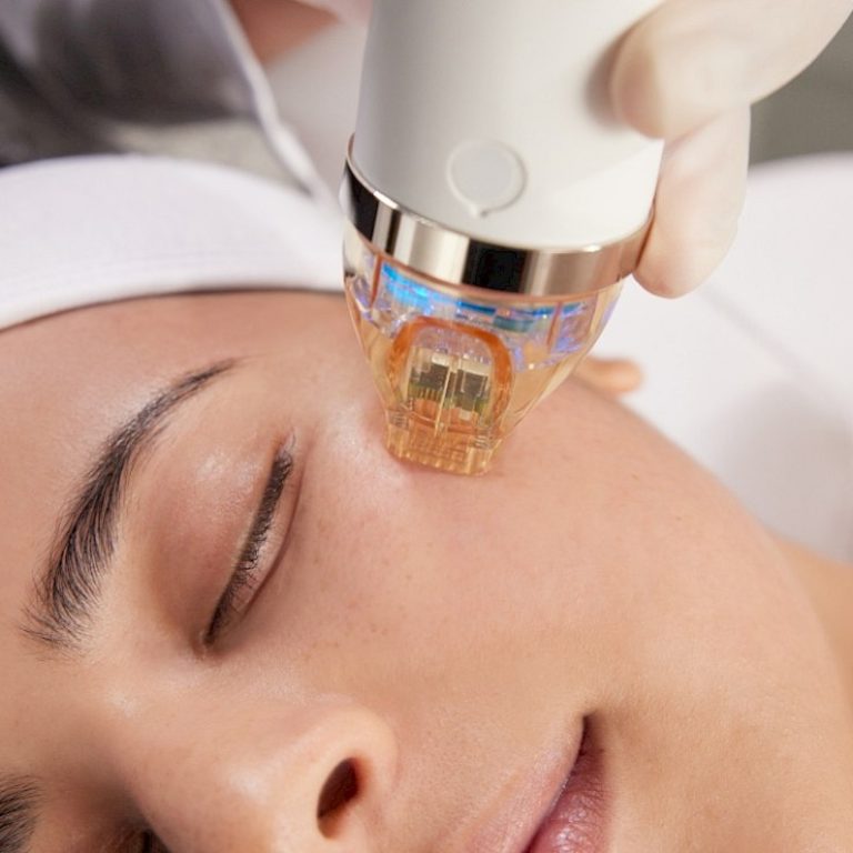 rf microneedling